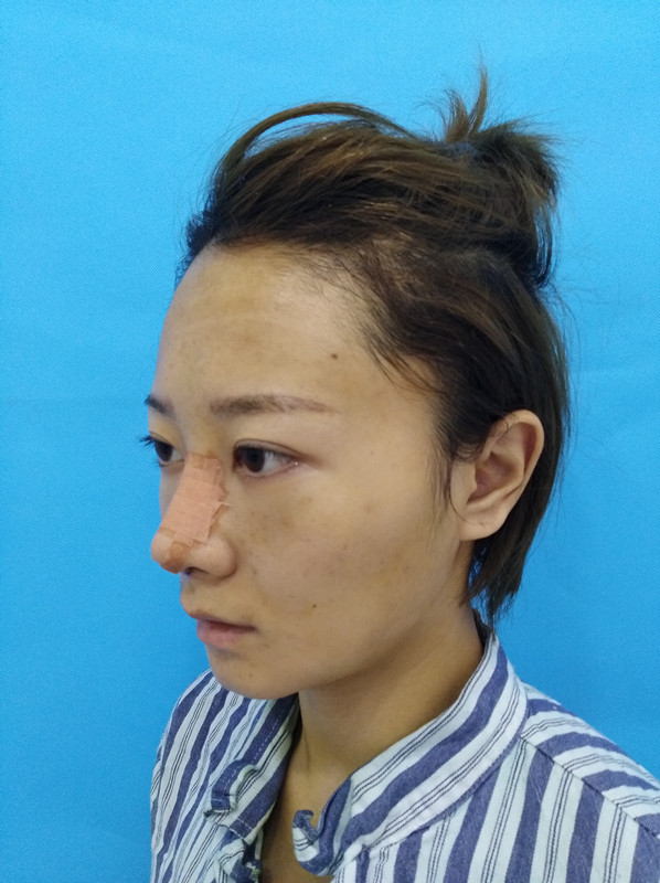 杭州迪美整形常德成医生做鼻综合整形技术怎么样？附鼻综合整形案例