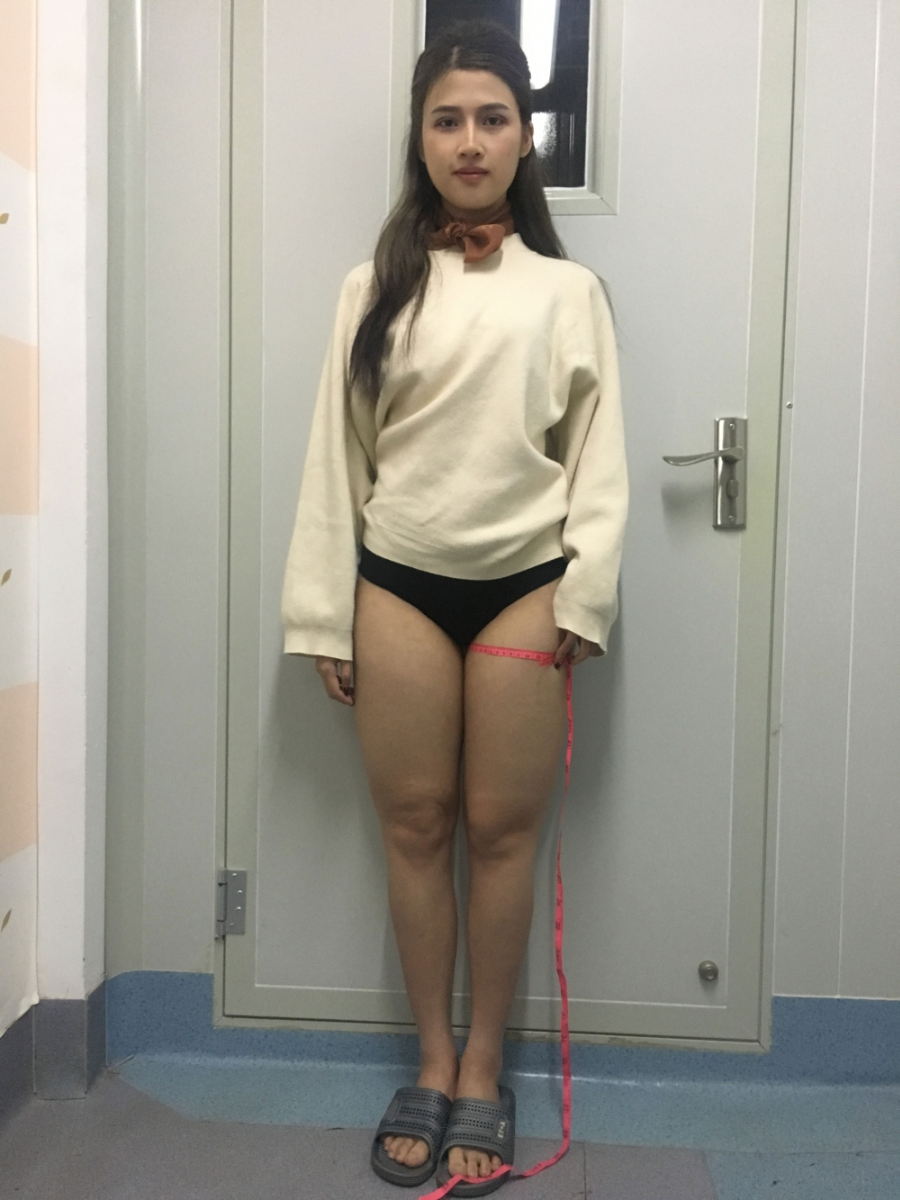 晋城凤凰整形美容医院宋发兴医生做大腿吸脂怎么样？附大腿吸脂案例