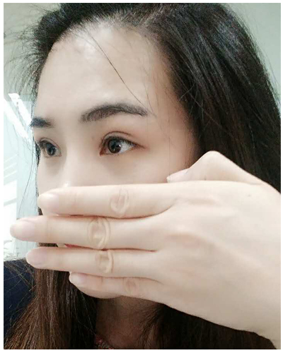 营口臻美医疗整形医生闫迎军做双眼皮效果怎么样？附双眼皮案例对比图