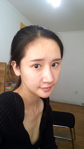 湛江澳泰整形医院彭鑫医生做自体脂肪丰苹果肌+太阳穴案例效果对比图
