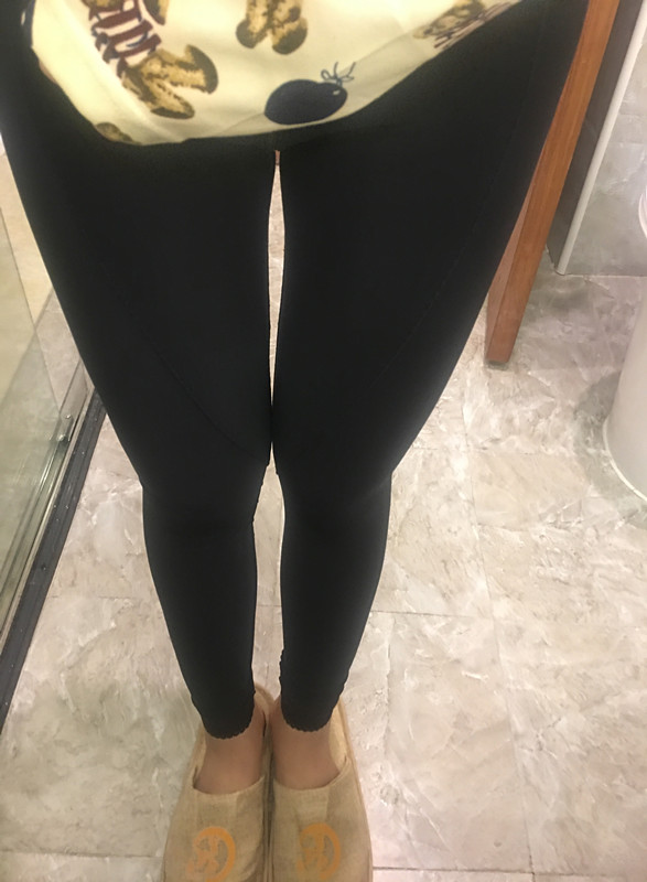 晋城凤凰整形美容医院宋发兴医生做大腿吸脂怎么样？附大腿吸脂案例