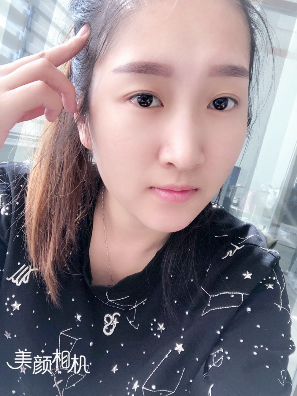 广州广大整形美容医院任生医生做玻尿酸丰面颊+注射瘦脸案例效果对比图