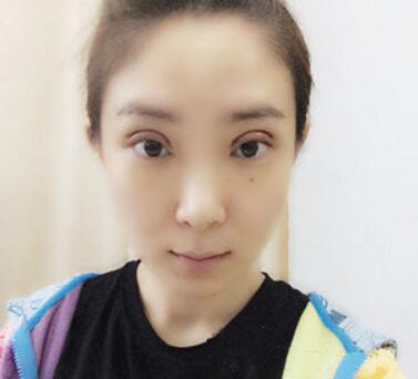 武汉中翰整形外科医院陈志鹏医生做双眼皮修复效果怎么样？附双眼皮修复案例