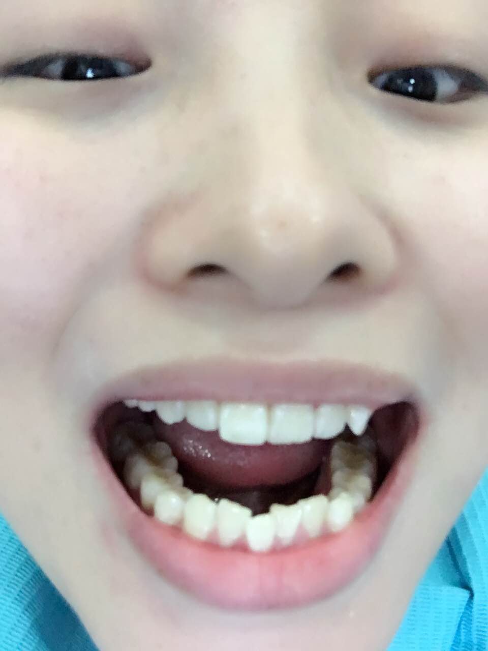 郑州壹加壹整形医院杨永利医生做牙齿隐形矫正怎么样？附牙齿隐形矫正案例