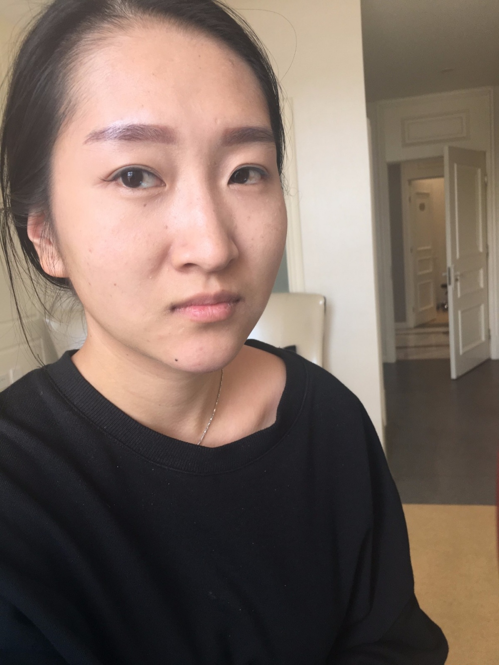 广州广大整形美容医院任生医生做玻尿酸丰面颊+注射瘦脸案例效果对比图