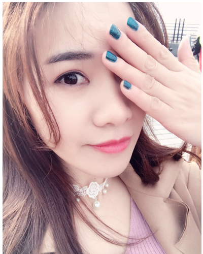 营口臻美医疗整形医生闫迎军做双眼皮效果怎么样？附双眼皮案例对比图