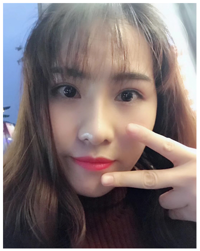 营口臻美医疗整形医生闫迎军做双眼皮效果怎么样？附双眼皮案例对比图