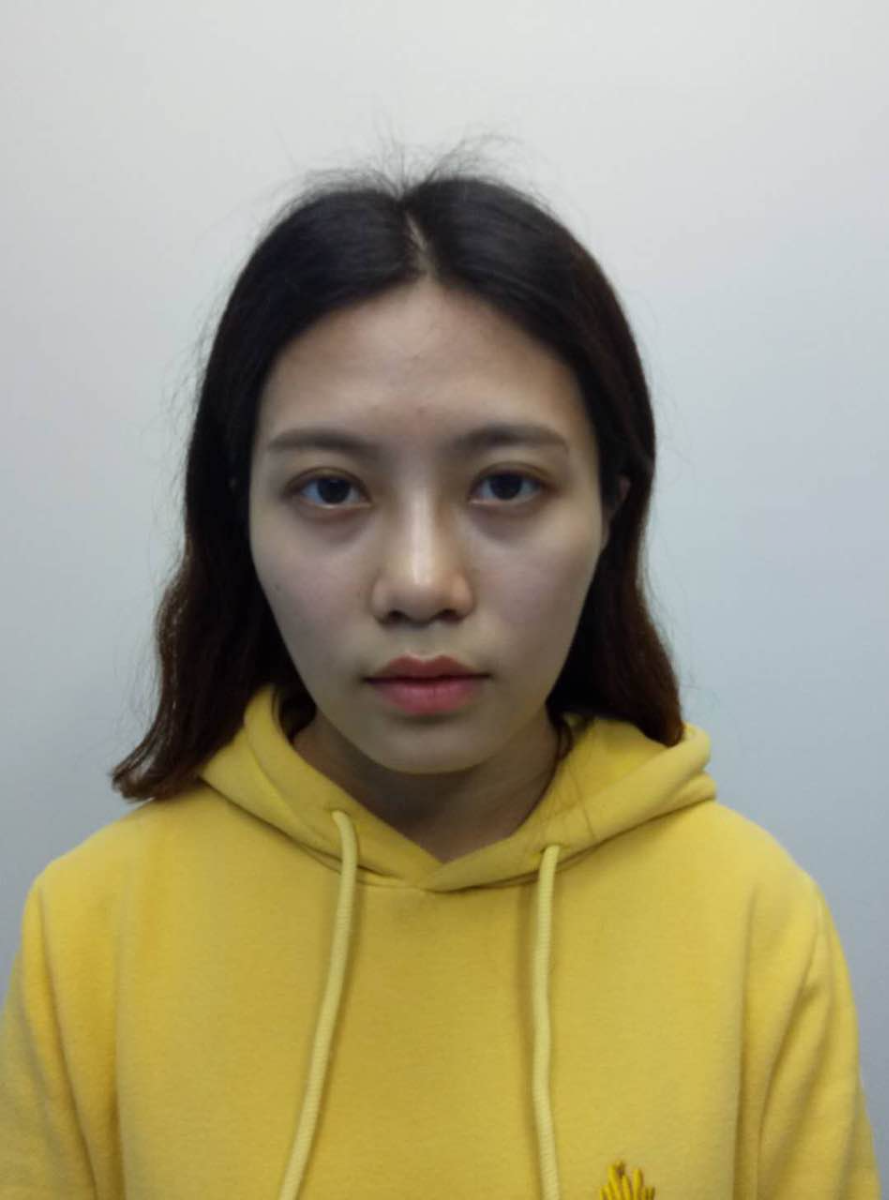 重庆美圣美邦整形医院刘力维医生做自体脂肪全脸填充案例效果对比图