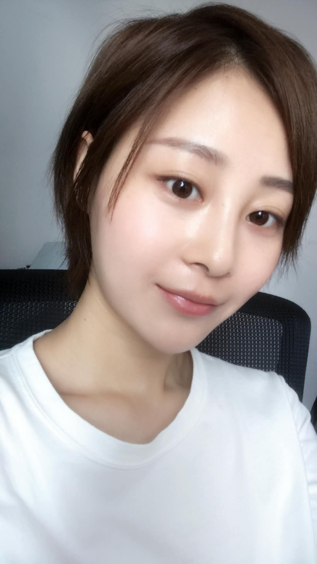 天津欧华威莎整形医生姚玲做面部埋线提升效果怎么样？附埋线提升案例