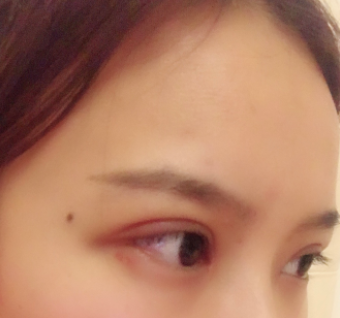 长春麦西美嘉整形医生王圣博做双眼皮手术效果怎么样？附双眼皮案例