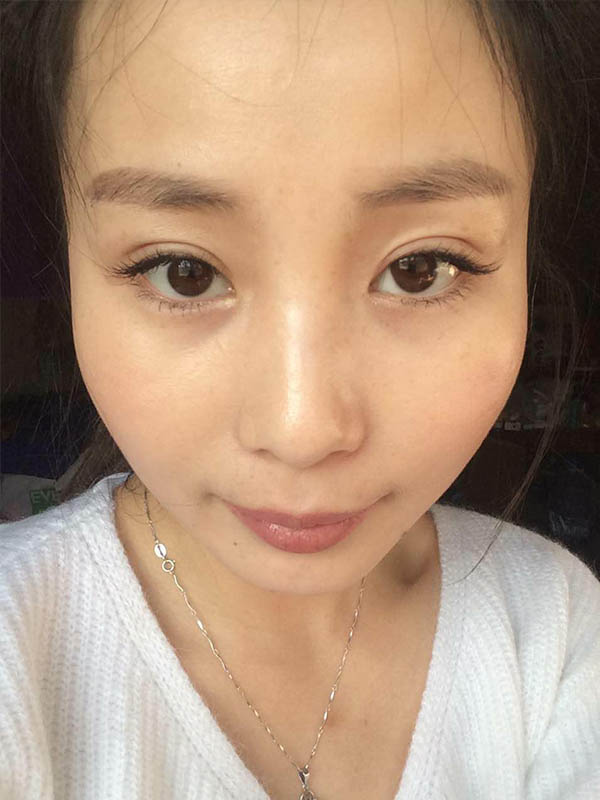 桂林新华医疗美容医生李新华做双眼皮手术怎么样？李新华双眼皮手术案例