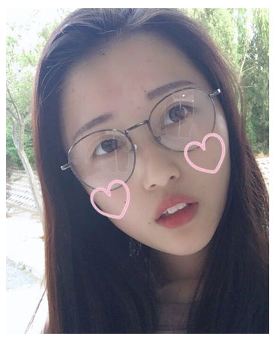 义乌傅氏口腔医生朱雨晴做牙齿隐形矫正效果怎么样？附牙齿隐形矫正案例