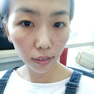 珠海蒂伊医疗整形医生廖俊凯做激光祛斑效果怎么样？附激光祛斑案例效果图