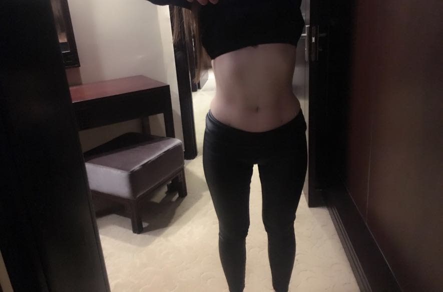 肇庆华美整形医院陈巍医生做腰腹吸脂效果怎么样？附腰腹吸脂案例