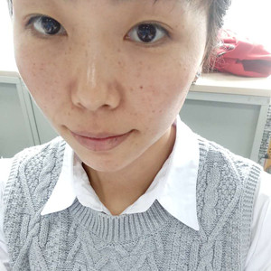 珠海蒂伊医疗整形医生廖俊凯做激光祛斑效果怎么样？附激光祛斑案例效果图