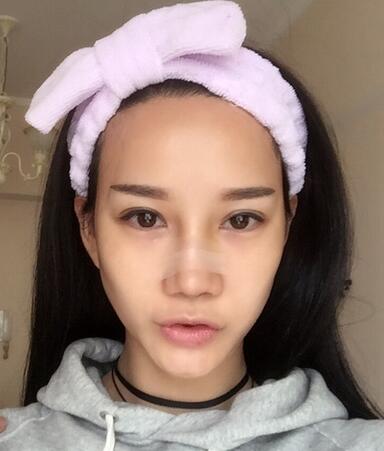 西安阳光整形医院邵萍医生做鼻综合整形怎么样？附鼻综合整形案例