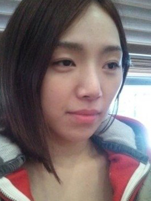 长春中妍整形医院吴学军医生做玻尿酸垫下巴+玻尿酸丰太阳穴案例效果对比图