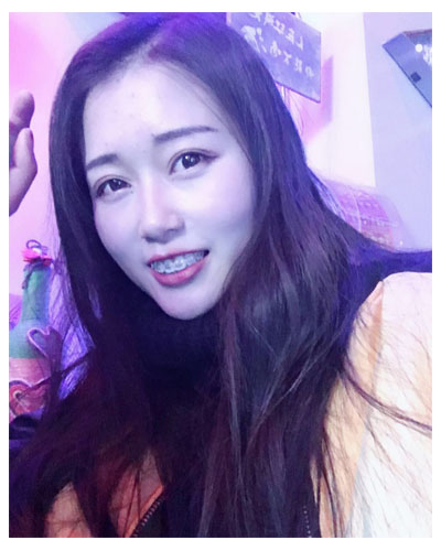 义乌傅氏口腔医生朱雨晴做牙齿隐形矫正效果怎么样？附牙齿隐形矫正案例
