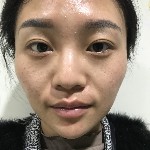 石家庄雅芳亚整形医生王文明做双眼皮+开眼角+鼻综合整形案例效果对比图
