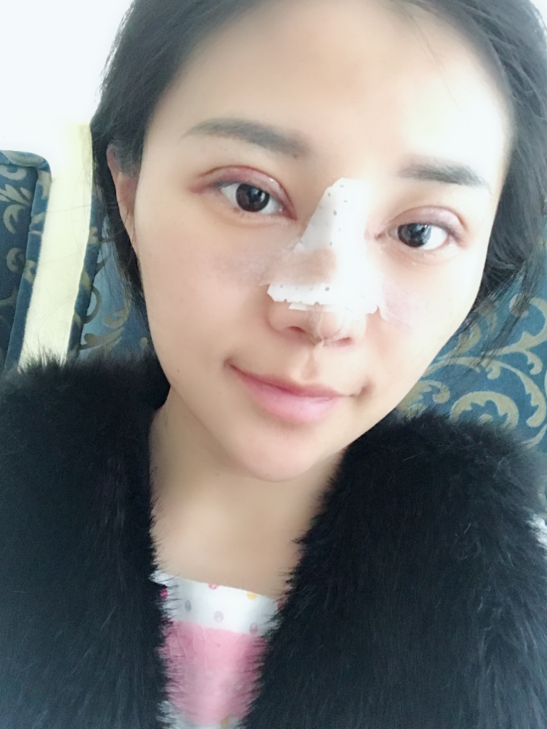 石家庄雅芳亚整形医生王文明做双眼皮+开眼角+鼻综合整形案例效果对比图