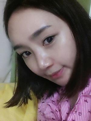 长春中妍整形医院吴学军医生做玻尿酸垫下巴+玻尿酸丰太阳穴案例效果对比图
