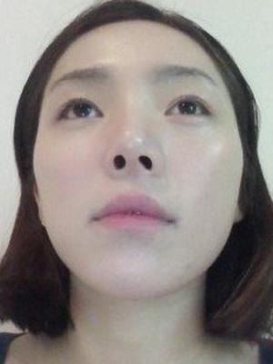 长春中妍整形医院吴学军医生做玻尿酸垫下巴+玻尿酸丰太阳穴案例效果对比图