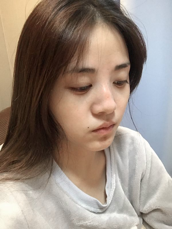 驻马店缔莱美医疗整形医生李冰做鼻综合整形怎么样？附鼻综合整形案例效果对比图