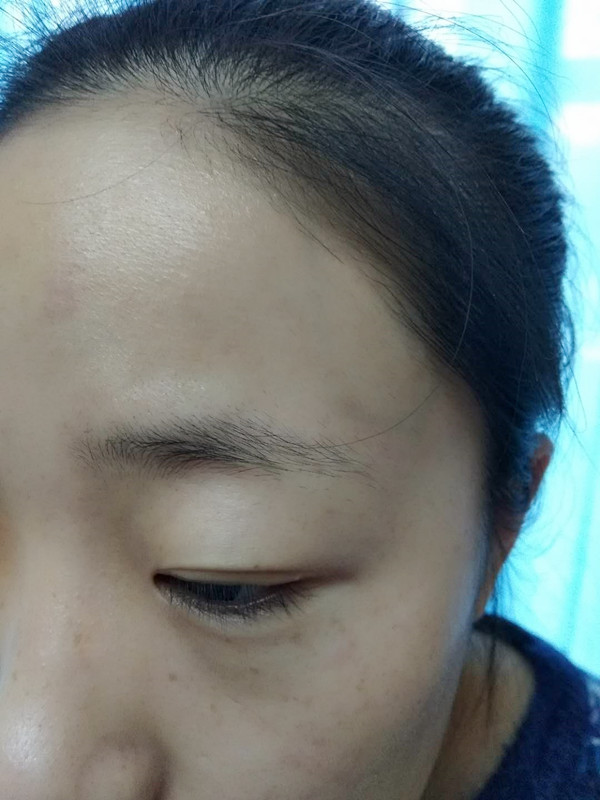 长沙爱思特医疗美容医院做半永久纹眉怎么样？附彭子娟医生案例效果图