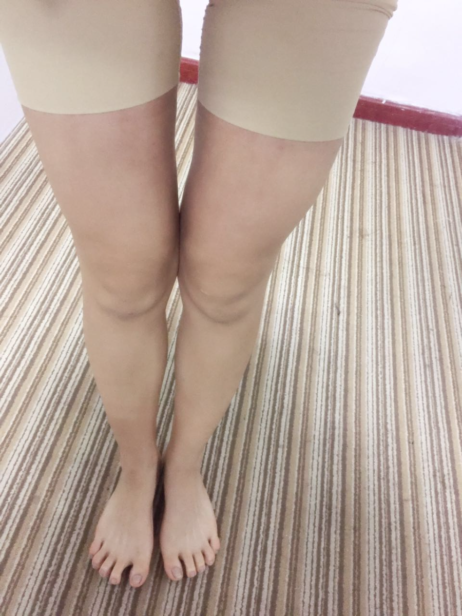北京蒂凡妮整形靳玉彪医生做大腿吸脂怎么样？附大腿吸脂案例效果对比图
