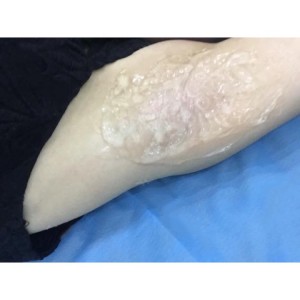 厦门张铭整医疗整形医生张小玲做激光脱腋毛怎么样？附激光脱腋毛效果对比图