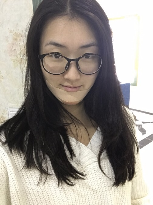 武汉中翰整形外科医院做硅胶垫下巴怎么样？附朱红霞医生案例效果对比图