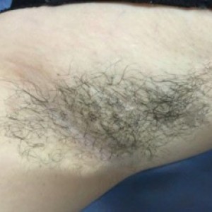 厦门张铭整医疗整形医生张小玲做激光脱腋毛怎么样？附激光脱腋毛效果对比图