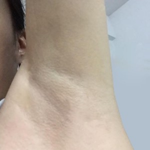 厦门张铭整医疗整形医生张小玲做激光脱腋毛怎么样？附激光脱腋毛效果对比图