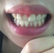 安徽天鹅湖口腔医院张永莉医生做牙齿矫正怎么样？附牙齿矫正案例效果对比图
