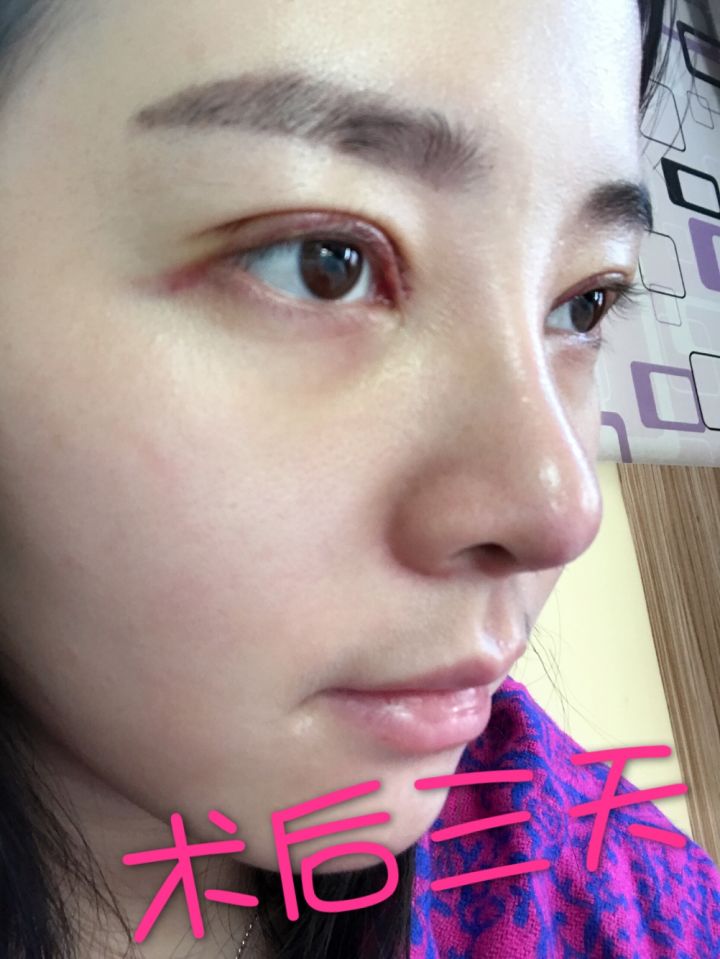 北京京韩整形医生王义山做埋线双眼皮怎么样？附案例效果对比图