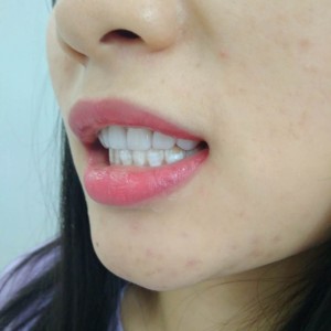 洛阳友好口腔医院医生李新然做牙贴面怎么样？附案例效果图