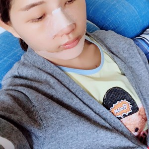 北京京民医院整形外科医生李鸿儒做硅胶隆鼻怎么样？附案例效果图