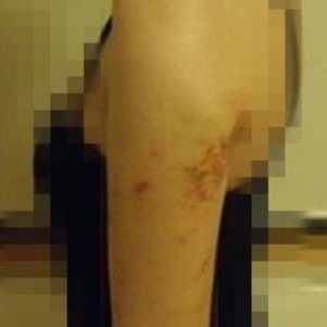 岳阳爱思特医疗美容医院医生王福生做手臂吸脂怎么样？附案例效果图