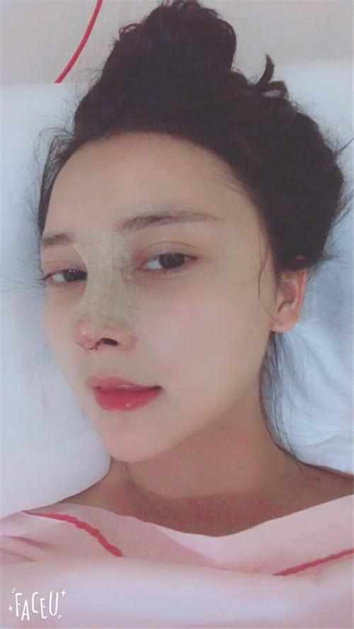 郑州华领医疗美容医院医生张永涛做硅胶假体隆鼻怎么样？附案例效果对比图