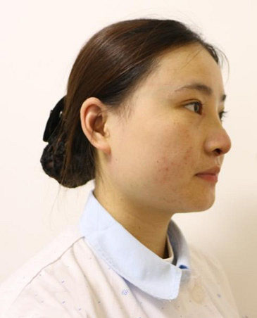 深圳阳光整形美容医院医生张平做膨体隆鼻+双眼皮+注射瘦脸案例效果对比图
