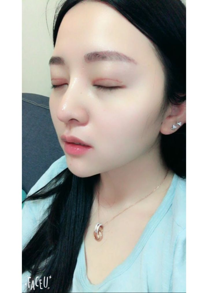 北京京韩整形医生王义山做埋线双眼皮怎么样？附案例效果对比图
