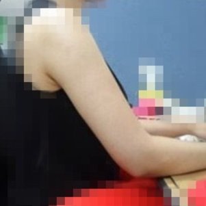 岳阳爱思特医疗美容医院医生王福生做手臂吸脂怎么样？附案例效果图
