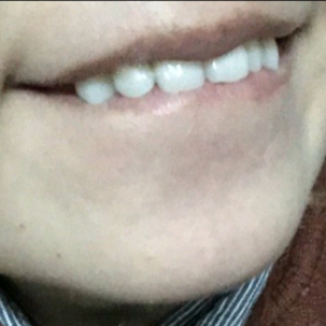 洛阳友好口腔医院医生杨爱芳做牙齿冷光美白怎么样？附案例效果图
