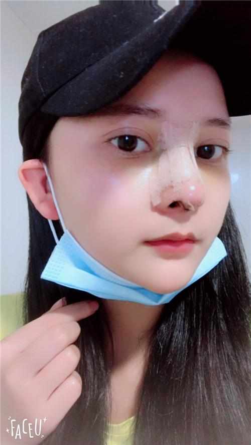 郑州华领医疗美容医院医生张永涛做硅胶假体隆鼻怎么样？附案例效果对比图