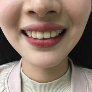 上海科瓦口腔医院医生邓建儒做牙齿冷光美白怎么样？附案例效果对比图