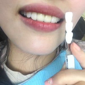 上海科瓦口腔医院医生邓建儒做牙齿冷光美白怎么样？附案例效果对比图