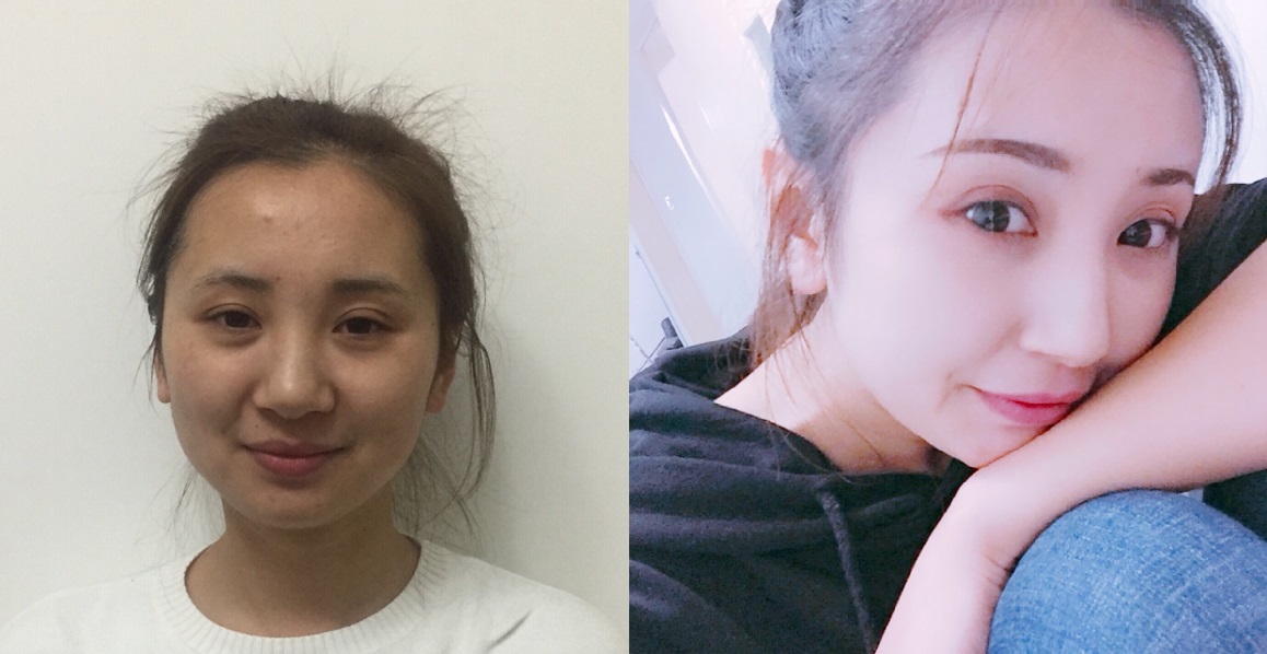 贵阳艺龄医疗美容门诊部医生李章做隆鼻手术怎么样？附案例效果对比图