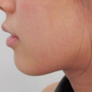 蚌埠韩美美莱整形医院医生张涛做玻尿酸垫下巴怎么样？来看案例效果图