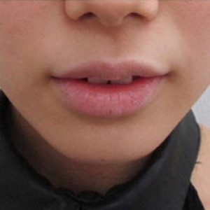 蚌埠韩美美莱整形医院医生张涛做玻尿酸垫下巴怎么样？来看案例效果图