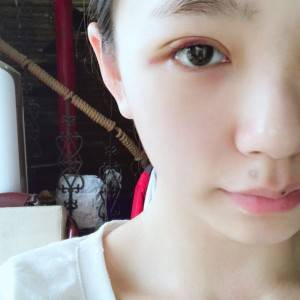 郑州安格润整形医生杨晓红做双眼皮手术怎么样？附案例效果图